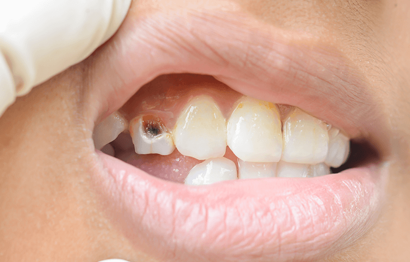 What To Do If You Have A Loose Or Displaced Tooth