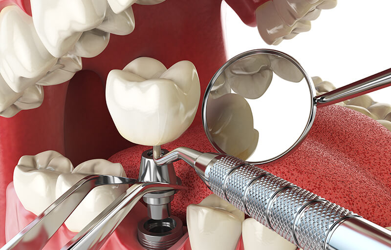 Planning For — and Recovering From — Tooth Extractions