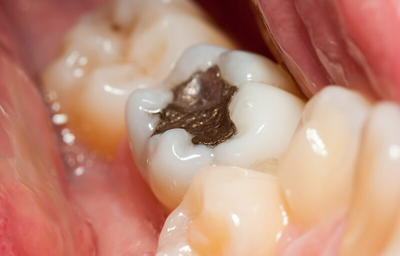 FAQ: Everything You Need to Know About Dental Fillings